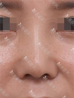 韩国星整形医院鼻子再次手术，术后鼻子美观又自然_术后