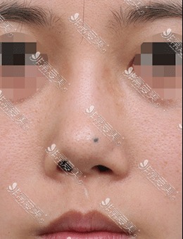 韩国星整形医院鼻头整形案例对比图，效果太好了！