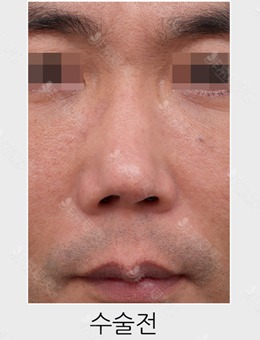 男士鼻修复前后对比图分享，苦等2个月终于变成正常人_术前