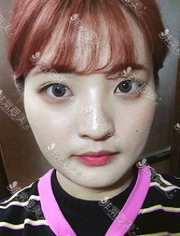 韩国DA整形打造换头女孩照片，轮廓和眼鼻整形技术真的强！