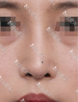 韩国星整形医院鼻头整形案例对比图，效果太好了！