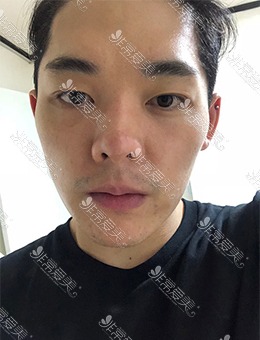 -韩国脸本脸骨整形外科男子颧骨缩小手术+鼻整形，恢复成效惊人！