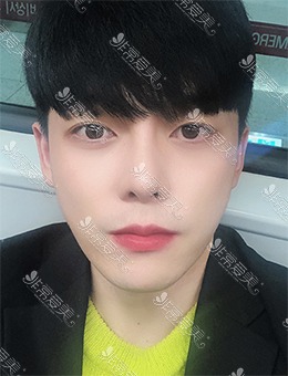 韩国脸本脸骨整形外科男子颧骨缩小手术+鼻整形，恢复成效惊人！_术后