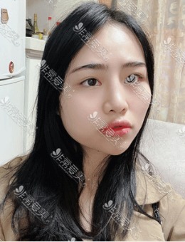 分享韩国脸本脸骨整形轮廓手术和眼鼻整形恢复过程图！_术前