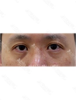 韩国眼底脂肪重排医院推荐梦美ggn整形外科,附案例!_术前