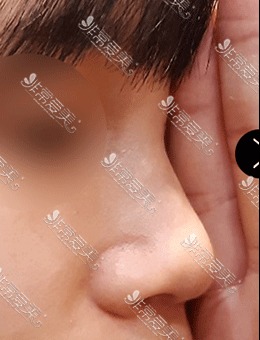 韩国美好MIHO整形耳软骨隆鼻手术案例对比图分享！_术前