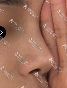 -韩国美好MIHO整形耳软骨隆鼻手术案例对比图分享！