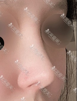 在韩国美好MIHO整形做了肋骨隆鼻，术后鼻型自然又好看！_术后