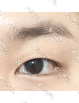 -来韩国icon整形做三重埋线修复双眼皮，灵动大眼睛你也可以拥有！
