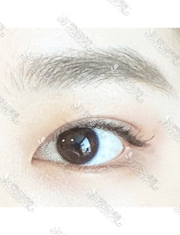 来韩国icon整形做三重埋线修复双眼皮，灵动大眼睛你也可以拥有！