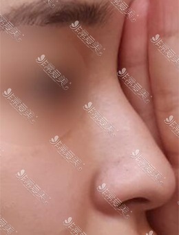 韩国美好MIHO整形外科驼峰鼻手术，还原自然流畅的鼻子_术前