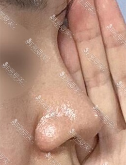 韩国美好MIHO整形外科驼峰鼻手术，精致立体的鼻子就是这样！_术后
