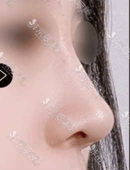 韩国MIHO美好整形做鼻子好吗？看驼峰鼻矫正图就知道！