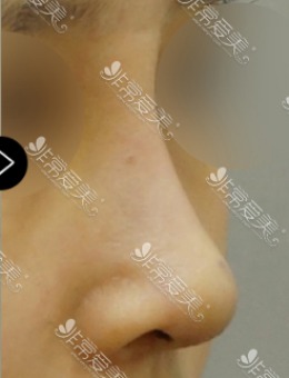 驼峰鼻矫正后真的太好看啦，韩国MIHO做鼻整形果然是让人放心！
