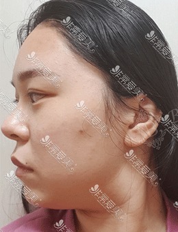 在韩国宝士丽医院做了面部吸脂手术，变身清纯美女！_术前