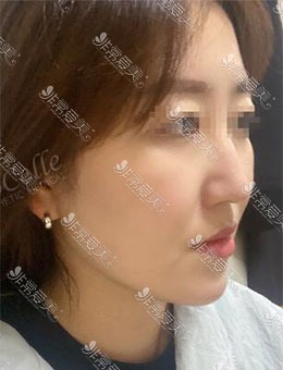 韩国宝士丽医院面部吸脂，术后面部轮廓清晰且减龄_术后