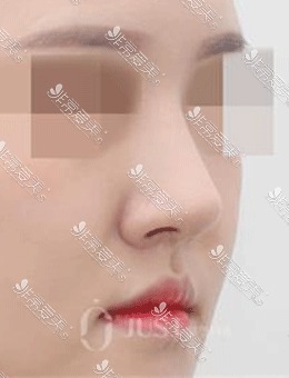 韩国JUST整形驼峰鼻矫正术前术后对比，鼻型简直太美了！_术后