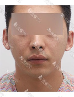 韩国JUST整形外科男士面部提拉+填充，术后精致小哥哥本人
