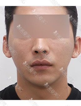 韩国JUST整形外科男士面部提拉+填充，术后精致小哥哥本人_术后