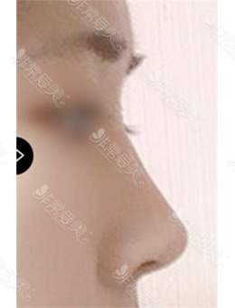 韩国做驼峰鼻子好的医院推荐美好MIHO整形,驼峰鼻矫正变化超棒!_术后