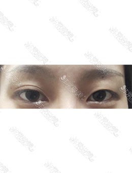韩国MIHO美好整形外科眼部整形，术后大变样！