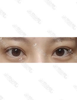 韩国MIHO美好整形外科眼部整形，术后大变样！