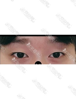-韩国美好MIHO整形自然粘连双眼皮+眼提肌术前术后对比照片分享！