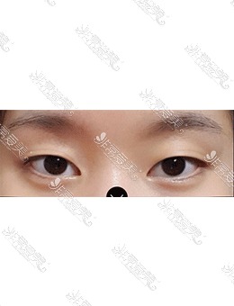 -在韩国美好MIHO整形做了自然粘连双眼皮+眼提肌手术，变身大眼萌妹！