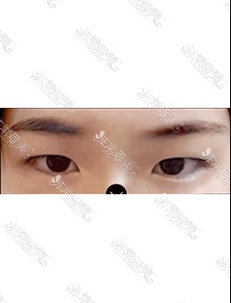 韩国美好MIHO整形自然粘连双眼皮+眼提肌手术对比照片！_术前