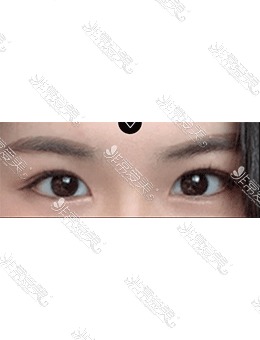 韩国美好MIHO整形自然粘连双眼皮+眼提肌手术对比照片！_术后