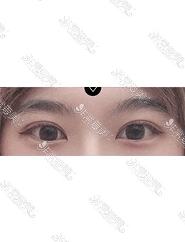 韩国美好MIHO整形自然粘连双眼皮+眼提肌手术对比照片，术后呈现灵动自然大眼睛！