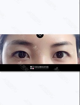 韩国美好MIHO整形外科自然粘连法双眼皮提肌效果真不错~_术后