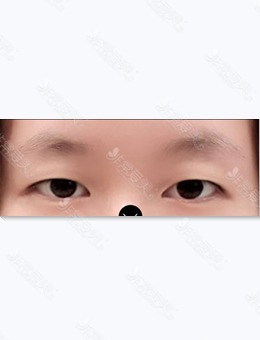 韩国美好MIHO双眼皮提肌对比照片来了,术后2个月就能恢复自然