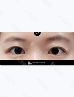 韩国美好MIHO双眼皮提肌对比照片来了,术后2个月就能恢复自然_术后