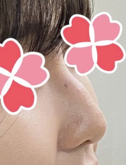 韩国4月31日整形外科弯鼻矫正病例前后对比_术前