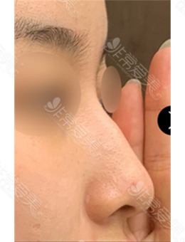  韩国美好MIHO整形驼峰鼻+鼻中隔手术前后变化图分享！_术前