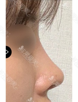  韩国美好MIHO整形驼峰鼻+鼻中隔手术前后变化图分享！_术后