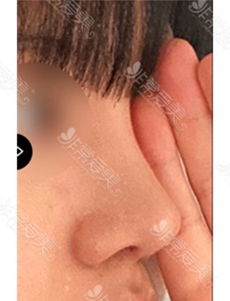 韩国缩鼻翼手术医院医生分享,推荐美好MIHO整形外科!