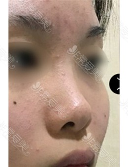 -韩国鼻中隔手术好的医院真人案例分享,术后鼻子变化惊艳！