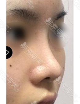 -韩国鼻中隔手术好的医院真人案例分享,术后鼻子变化惊艳！