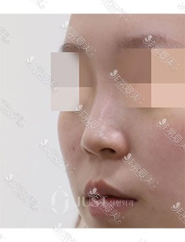 -韩国JUST整形外科塌鼻整形手术，富有立体感的鼻子就是这样