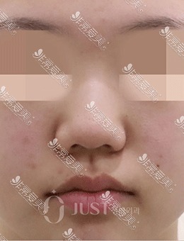 韩国JUST整形朝天鼻塌鼻矫正手术案例，术前术后对比超明显！