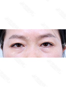 -韩国星愿Byul整形医院眼部修复手术与眼底脂肪重置对比照!