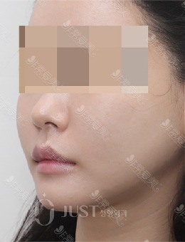 改善脸部轮廓做什么整形？韩国JUST脸部提升前后对比明显