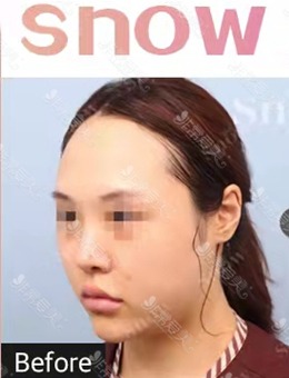 韩国SNOW整形外科面部脂肪填充和吸脂一起做多角度对比分析_术前