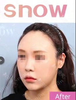 韩国SNOW整形外科面部脂肪填充和吸脂一起做多角度对比分析_术后