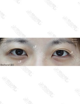 -韩国IOU整形外科双眼皮手术，后悔没有早点做！