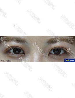 -韩国IOU整形外科双眼皮手术，后悔没有早点做！