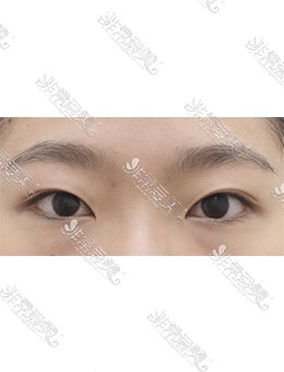 韩国AND整形自然粘连双眼皮+开眼角手术照片分享！_术前