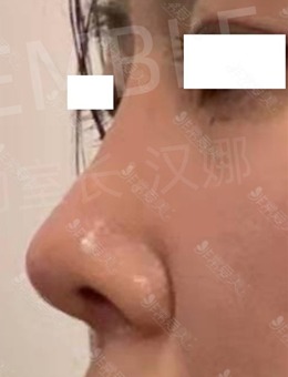 韩国人做的鼻子太自然了，这组鼻综合手术前后对比照片就是证据_术后